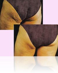 Cavitação Description