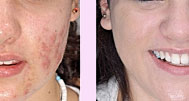 Tratamento para peles com acnes