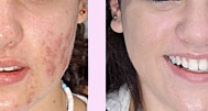 Tratamento para peles com acnes Tratamento para peles com acnes